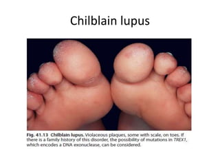 Chilblain lupus
 