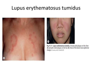 Lupus erythematosus tumidus
 