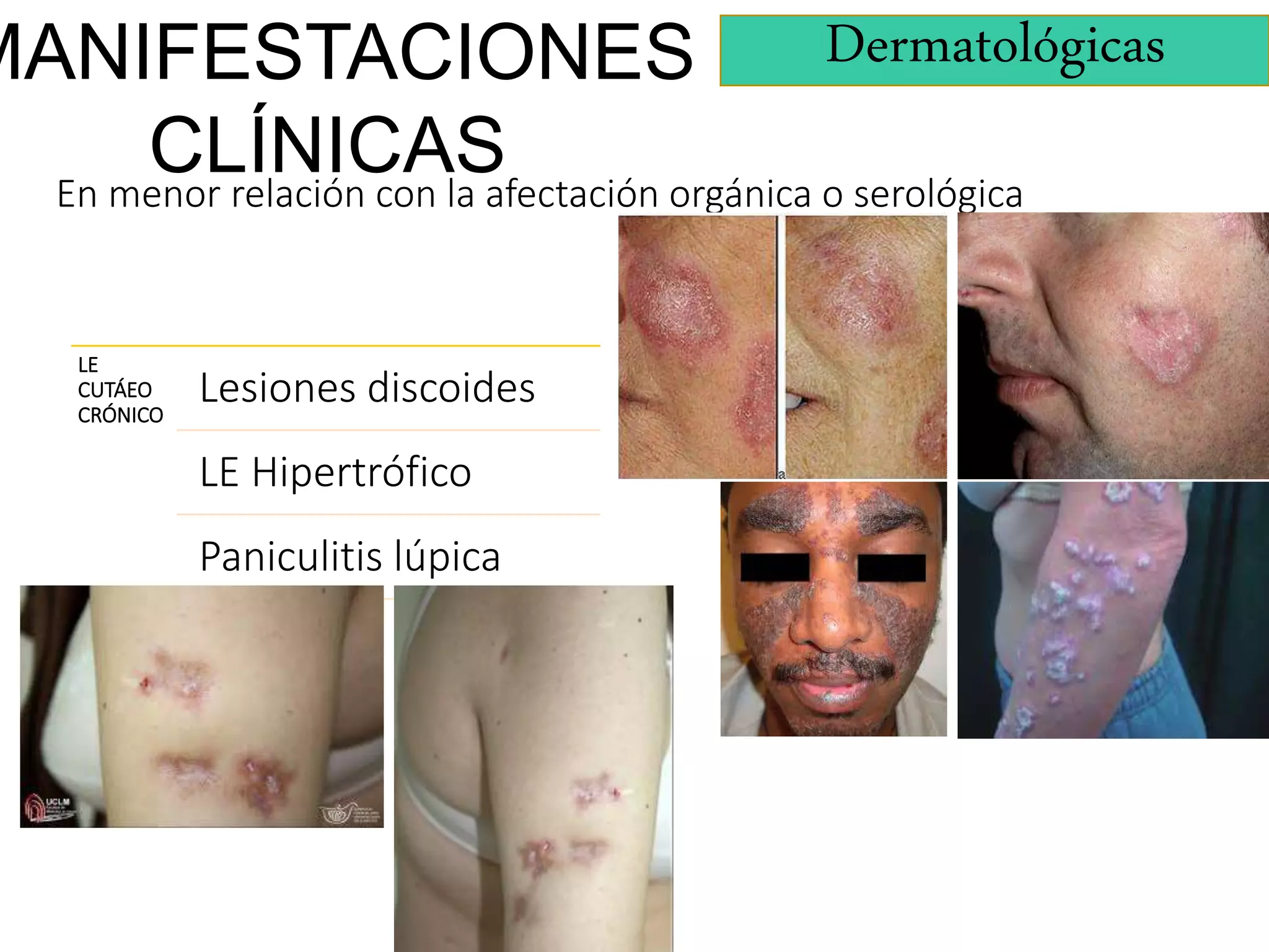 Lupus eritematoso sistémico (LES) y Síndrome antifosfolípidos | PPT