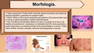 ✓ Vasos sanguíneos: Puede existir vasculitis aguda necrosante que afecta las
arterias pequeñas y arteriolas de cualquier tejido.
✓ Riñón: Hasta un 50% de los pacientes que padecen LES presenta fallo renal
en forma en glomerulonefritis y nefritis tubulointersticial
✓ Piel: El eritema característico afecta a la cara y al puente de la nariz y las
mejillas (el exantema en «mariposa») en alrededor del 50% de los pacientes, y
puede observarse un exantema similar en las extremidades y el tronco. Puede
haber también urticaria, ampollas, lesiones maculopapulares y úlceras.
 