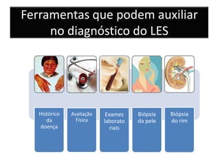 Ferramentas que podem auxiliar
     no diagnóstico do LES




   Histórico   Avaliação    Exames    Biópsia   Biópsia
      da         Física    laborato   da pele   do rim
   doença                     riais
 