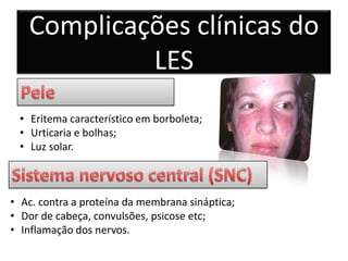 Complicações clínicas do
            LES
 • Eritema característico em borboleta;
 • Urticaria e bolhas;
 • Luz solar.



• Ac. contra a proteína da membrana sináptica;
• Dor de cabeça, convulsões, psicose etc;
• Inflamação dos nervos.
 
