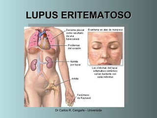 Lupus Eritematoso Sistemico
