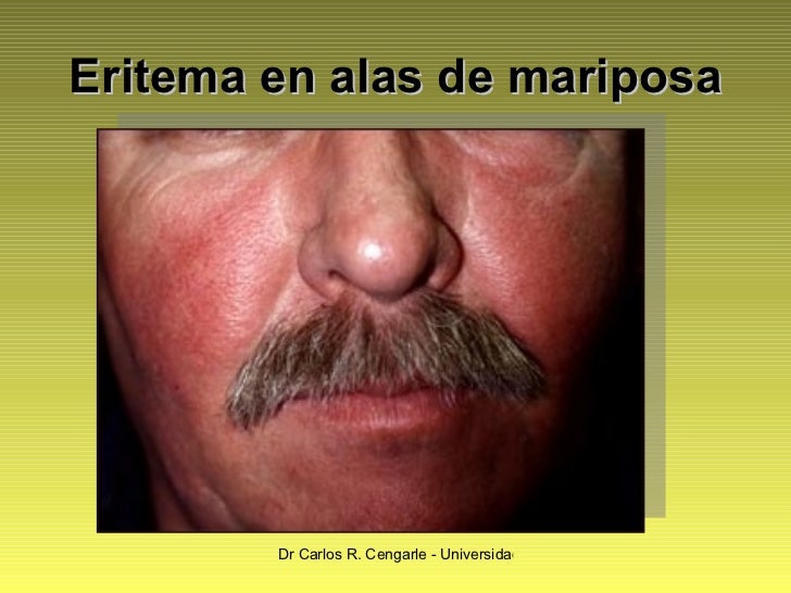 Lupus Eritematoso Sistemico