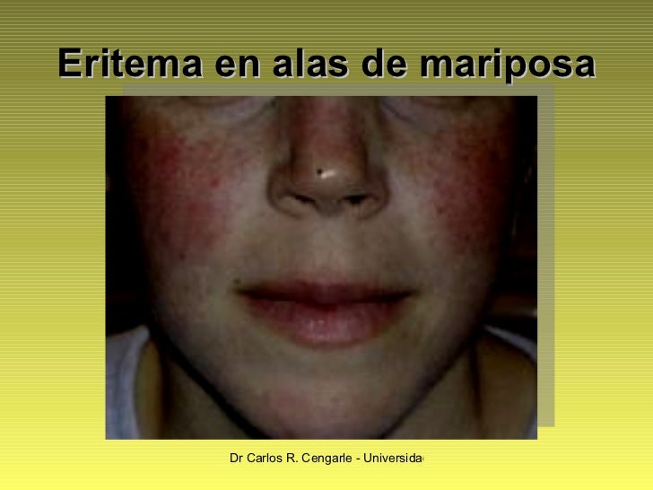 Lupus Eritematoso Sistemico