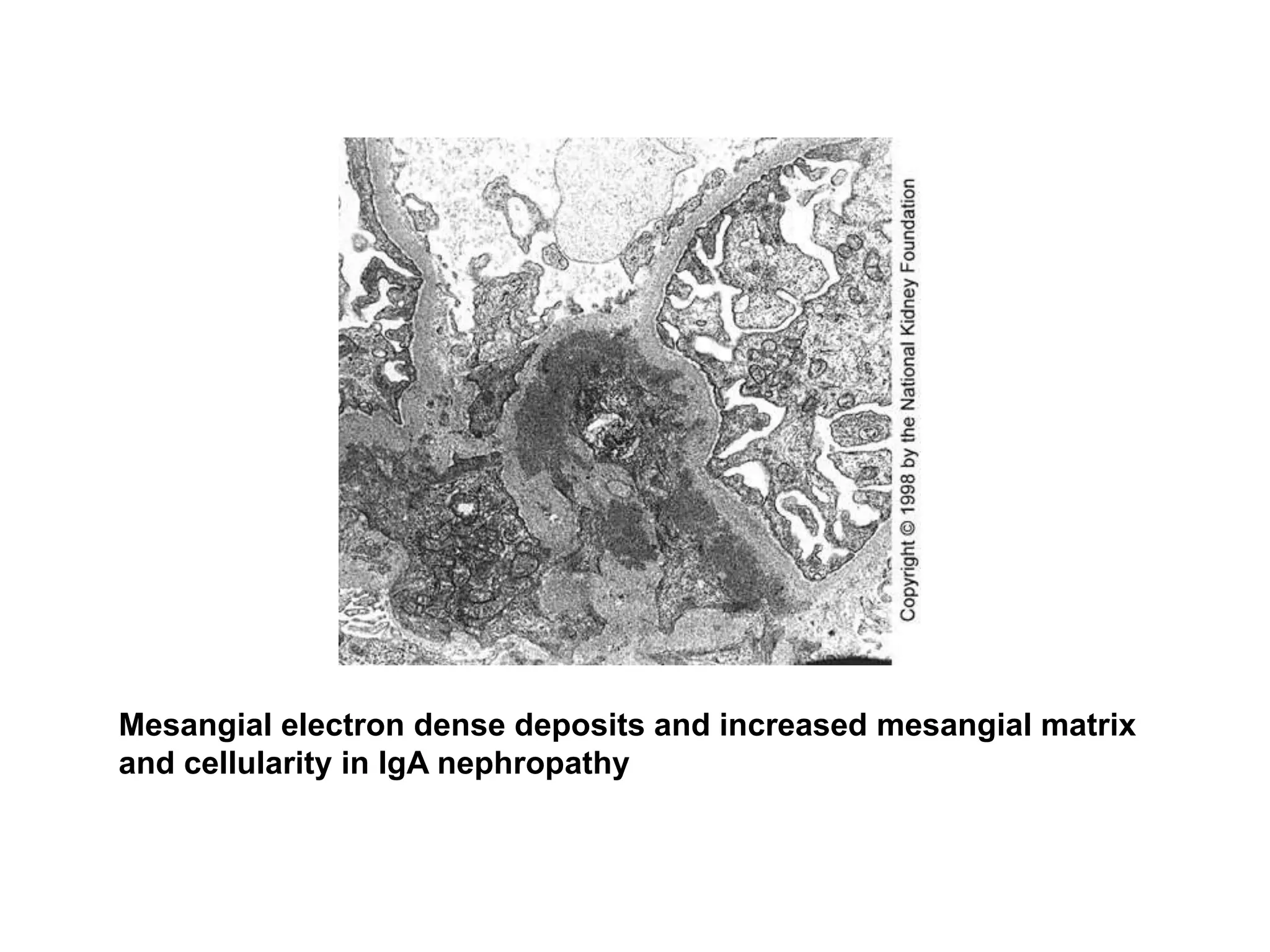 Mesangial electron dense deposits and increased mesangial matrix
and cellularity in IgA nephropathy
 