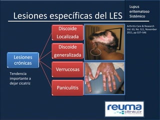 Lesiones específicas del LES
Tendencia
importante a
dejar cicatriz
Arthritis Care & Research
Vol. 63, No. S11, November
2011, pp S37–S46
 