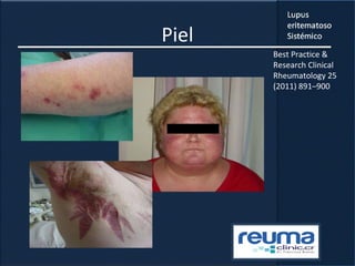 Piel
Best Practice &
Research Clinical
Rheumatology 25
(2011) 891–900
 