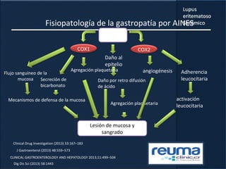 Fisiopatología de la gastropatía por AINES
Clinical Drug Investigation (2013) 33:167–183
AINES
COX2COX1
Adherencia
leucocitaria
angiogénesis
Daño al
epitelio
Daño por retro difusión
de ácido
Agregación plaquetaria
activación
leucocitaria
Agregación plaquetaria
Secreción de
bicarbonato
Flujo sanguíneo de la
mucosa
Mecanismos de defensa de la mucosa
Lesión de mucosa y
sangrado
J Gastroenterol (2013) 48:559–573
CLINICAL GASTROENTEROLOGY AND HEPATOLOGY 2013;11:499–504
Dig Dis Sci (2013) 58:1443
 