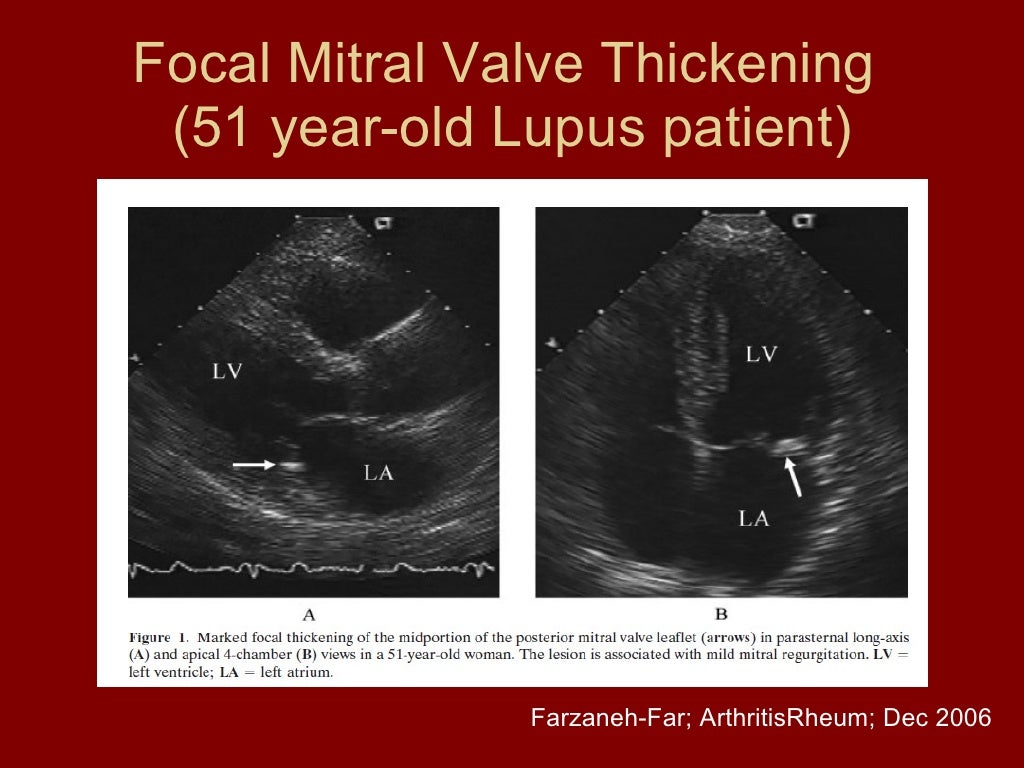 Lupus and cardiovascular disease
