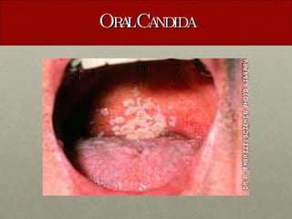 Oral Candida