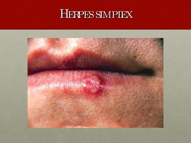 Lupus and dental issues