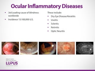  3rd Leading cause of blindness
worldwide
 Incidence 15:100,000 U.S.
OcularInflammatoryDiseases
These include:
 Dry Eye Disease/Keratitis
 Uveitis
 Scleritis
 Retinitis
 Optic Neuritis
 