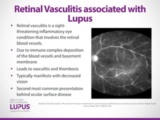  Retinal vasculitis is a sight-
threatening inflammatory eye
condition that involves the retinal
blood vessels.
 Due to immune complex deposition
of the blood vessels and basement
membrane
 Leads to vasculitis and thombosis
 Typically manifests with decreased
vision
 Second most common presentation
behind ocular surface disease
RetinalVasculitisassociatedwith
Lupus
Sitaula R, Shah DN, Singh D. The spectrum of ocular involvement in systemic lupus erythematosus in a tertiary eye care center in Nepal. Ocular
Immun Inflam 2011;19(6):422-425
 