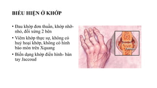 BIỂU HIỆN Ở KHỚP
• Đau khớp đơn thuần, khớp nhỡ-
nhỏ, đối xứng 2 bên
• Viêm khớp thực sự, không có
huỷ hoại khớp, không có hình
bào mòn trên Xquang
• Biến dạng khớp điển hình- bàn
tay Jaccoud
 