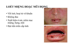 LOÉT MIỆNG HOẶC MŨI HỌNG
• Vết loét, hoại tử vô khuẩn
• Không đau
• Xuất hiện ở má, niêm mạc
miệng, họng, mũi
• Đợt tiến triển cấp tính
 