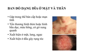 BAN ĐỎ DẠNG ĐĨA Ở MẶT VÀ THÂN
• Gặp trong thể bán cấp hoặc mạn
tính
• Tổn thương hình thòn hoặc hình
bầu dục, màu hồng, có gở xung
quanh
• Xuất hiện ở mặt, lưng, ngực
• Xuất hiện ở đầu gây rụng tóc
 