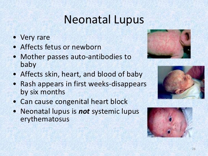 Lupus