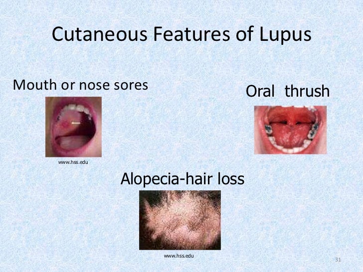 Lupus
