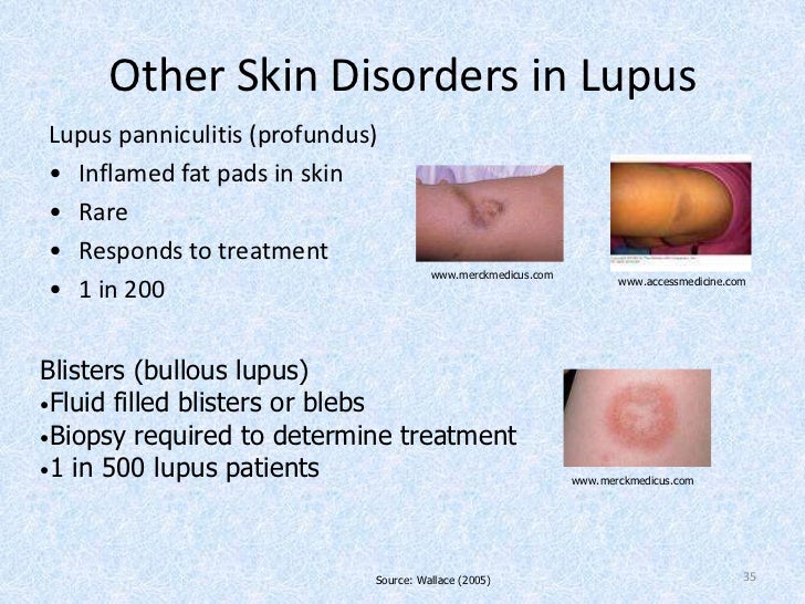 Lupus Profundus - A Variant of Cutaneous Lupus