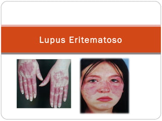 Lupus Eritematoso

 
