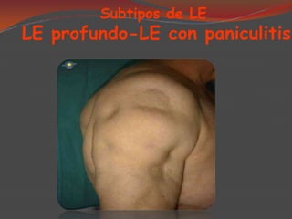 Subtipos de LE

LE profundo-LE con paniculitis

 
