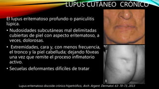 LUPUS CUTÁNEO CRÓNICO
Lupus eritematoso discoide crónico hipertrófico, Arch. Argent. Dermatol. 63: 70-73, 2013
El lupus er...