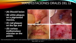 MANIFESTACIONES ORALES DEL LE
• (A) Discoid lesion
• (B) white plaques
on a pigmented
mucosa,
• (C) red plaques
on the lip...