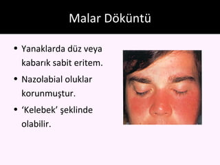 Malar Döküntü

• Yanaklarda düz veya
  kabarık sabit eritem.
• Nazolabial oluklar
  korunmuştur.
• ‘Kelebek’ şeklinde
  olabilir.
 