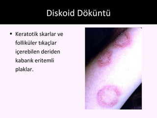 Diskoid Döküntü

• Keratotik skarlar ve
  folliküler tıkaçlar
  içerebilen deriden
  kabarık eritemli
  plaklar.
 