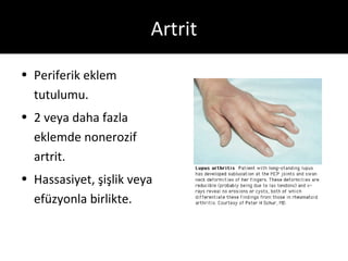 Artrit

• Periferik eklem
  tutulumu.
• 2 veya daha fazla
  eklemde nonerozif
  artrit.
• Hassasiyet, şişlik veya
  efüzyonla birlikte.
 