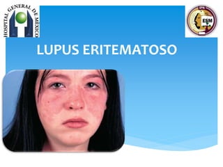 LUPUS ERITEMATOSO
 