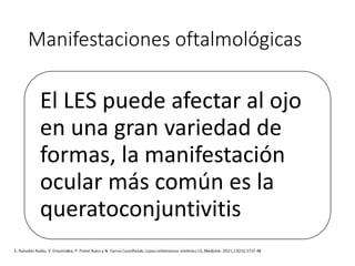 Manifestaciones oftalmológicas
El LES puede afectar al ojo
en una gran variedad de
formas, la manifestación
ocular más común es la
queratoconjuntivitis
 