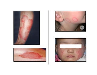 Tiña de la cara Lepra tuberciloide
▪ Puede afectar a
cualquier grupo
de edad, se observa mas
frecuentemente en niños
y adu...
