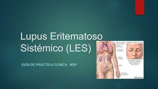 Lupus Eritematoso
Sistémico (LES)
GUÍA DE PRÁCTICA CLÍNICA MSP
 