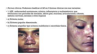  Formas clínicas. Podemos clasificar el LE en 3 formas clínicas con sus variantes:
 1. LES: enfermedad autoinmune, crónica, inflamatoria y multisistémica, que
evoluciona con períodos de remisión, afecta piel, mucosas, articulaciones, riñones,
sistema nervioso, serosas y otros órganos
 a) Eritema malar.
 b) Eritema papular diseminado.
 c) Eritema ampollar tipo eritema multiforme o necrólisis tóxica.
 