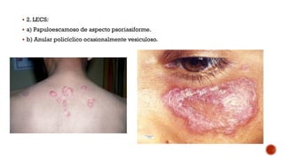  2. LECS:
 a) Papuloescamoso de aspecto psoriasiforme.
 b) Anular policíclico ocasionalmente vesiculoso.
 