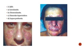  3. LED:
 a) Localizado.
 b) Generalizado.
 c) Discoide hipertrófico.
 d) Lupus profundo.
 