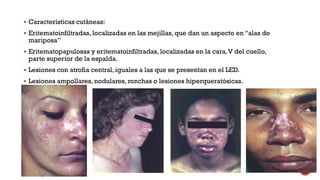  Características cutáneas:
 Eritematoinfiltradas, localizadas en las mejillas, que dan un aspecto en “alas de
mariposa”
 Eritematopapulosas y eritematoinfiltradas, localizadas en la cara,V del cuello,
parte superior de la espalda.
 Lesiones con atrofia central, iguales a las que se presentan en el LED.
 Lesiones ampollares, nodulares, ronchas o lesiones hiperqueratósicas.
 