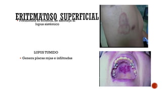  Predomina el eritema, se asemeja al
lupus sistémico
LUPUS TUMIDO
 Genera placas rojas e infiltradas
 