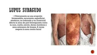  Clínicamente es una erupción
fotosensible, recurrente, superficial,
simétrica, no indurada y no cicatricial.
Afecta la zona de piel fotoexpuesta como
la cara, cuello, escote, dorso, hombros y
zona extensora de brazos. A veces
respeta la zona centro facial
 