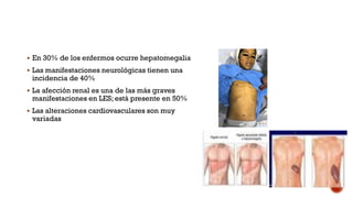  En 30% de los enfermos ocurre hepatomegalia
 Las manifestaciones neurológicas tienen una
incidencia de 40%
 La afección renal es una de las más graves
manifestaciones en LES; está presente en 50%
 Las alteraciones cardiovasculares son muy
variadas
 