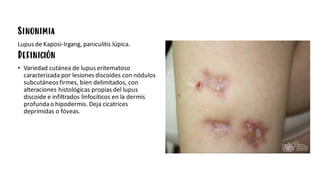 Sinonimia
Lupus de Kaposi-Irgang, paniculitis lúpica.
Definición
• Variedad cutánea de lupus eritematoso
caracterizada por lesiones discoides con nódulos
subcutáneosfirmes, bien delimitados, con
alteraciones histológicas propias del lupus
discoide e infiltrados linfocíticos en la dermis
profundao hipodermis. Deja cicatrices
deprimidas o fóveas.
 