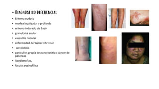 • Diagnóstico diferencial
• Eritema nudoso
• morfea localizada o profunda
• eritema indurado de Bazin
• granuloma anular
• vasculitis nodular
• enfermedad de Weber-Christian
• sarcoidosis
• paniculitis propia de pancreatitis o cáncer de
páncreas
• lipodistrofias,
• fascitis eosinofílica
 