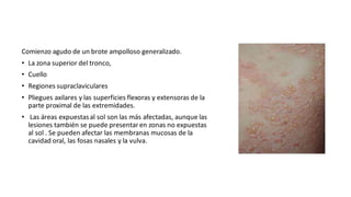 Comienzo agudo de un brote ampolloso generalizado.
• La zona superior del tronco,
• Cuello
• Regiones supraclaviculares
• Pliegues axilares y las superficies flexoras y extensoras de la
parte proximal de las extremidades.
• Las áreas expuestasal sol son las más afectadas, aunque las
lesiones también se puede presentaren zonas no expuestas
al sol . Se pueden afectar las membranas mucosas de la
cavidad oral, las fosas nasales y la vulva.
 