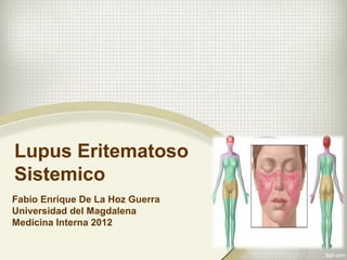 Lupus Eritematoso
Sistemico
Fabio Enrique De La Hoz Guerra
Universidad del Magdalena
Medicina Interna 2012
 