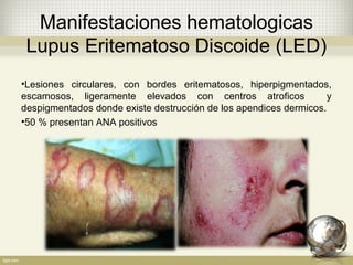 Lupus eritematoso sistemico | PPT