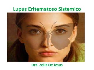 Lupus Eritematoso Sistemico




       Dra. Zoila De Jesus
 