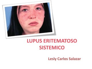 LUPUS ERITEMATOSO
SISTEMICO
Lesly Carlos Salazar
 
