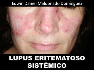 LUPUS ERITEMATOSO
SISTÉMICO
Edwin Daniel Maldonado Domínguez
 